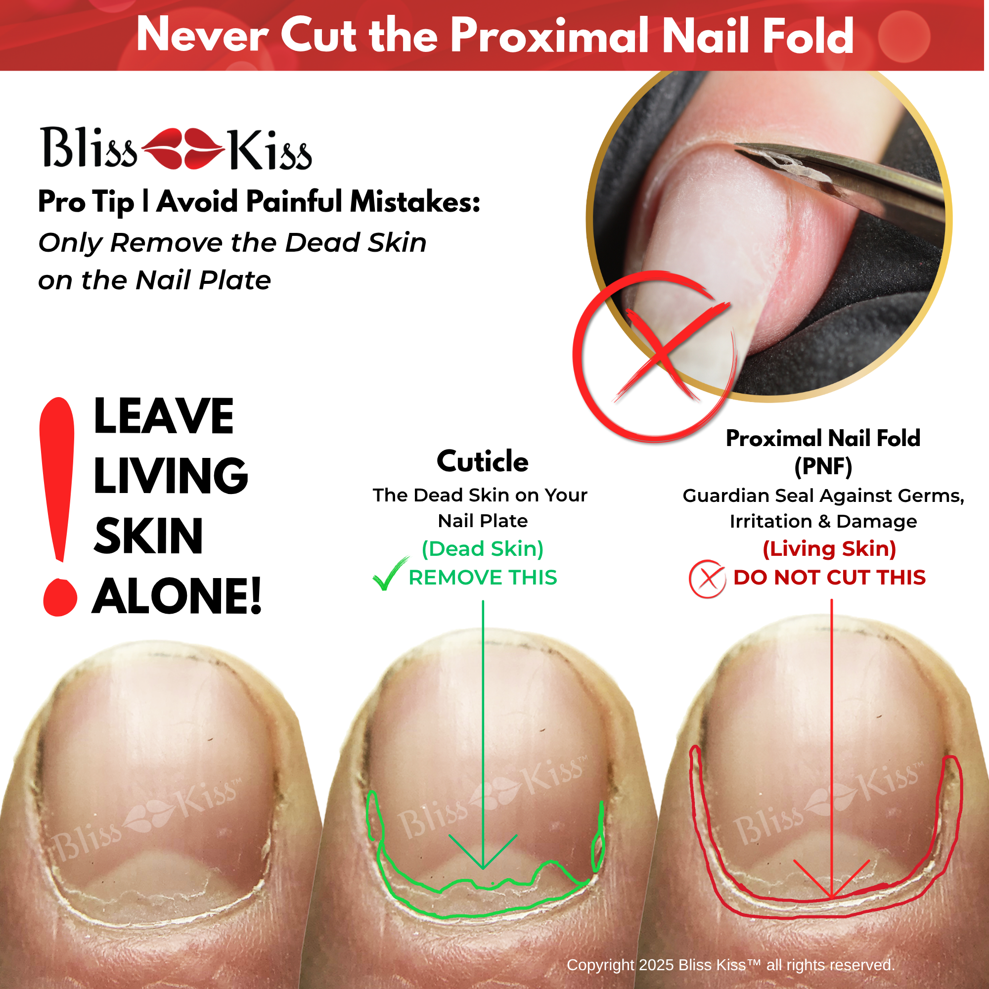 Never Cut the Proximal Nail Fold
Bliss Kiss
Pro Tip Avoid Painful Mistakes:
Only remove the dead skin on the nail plate.
Below shows a diagram of the layers of the skin on a nail bed. Cuticle skin can be seen on the nail. Proximal Nail fold skin (the sin around the finger nail) DO NOT CUT THIS AREA