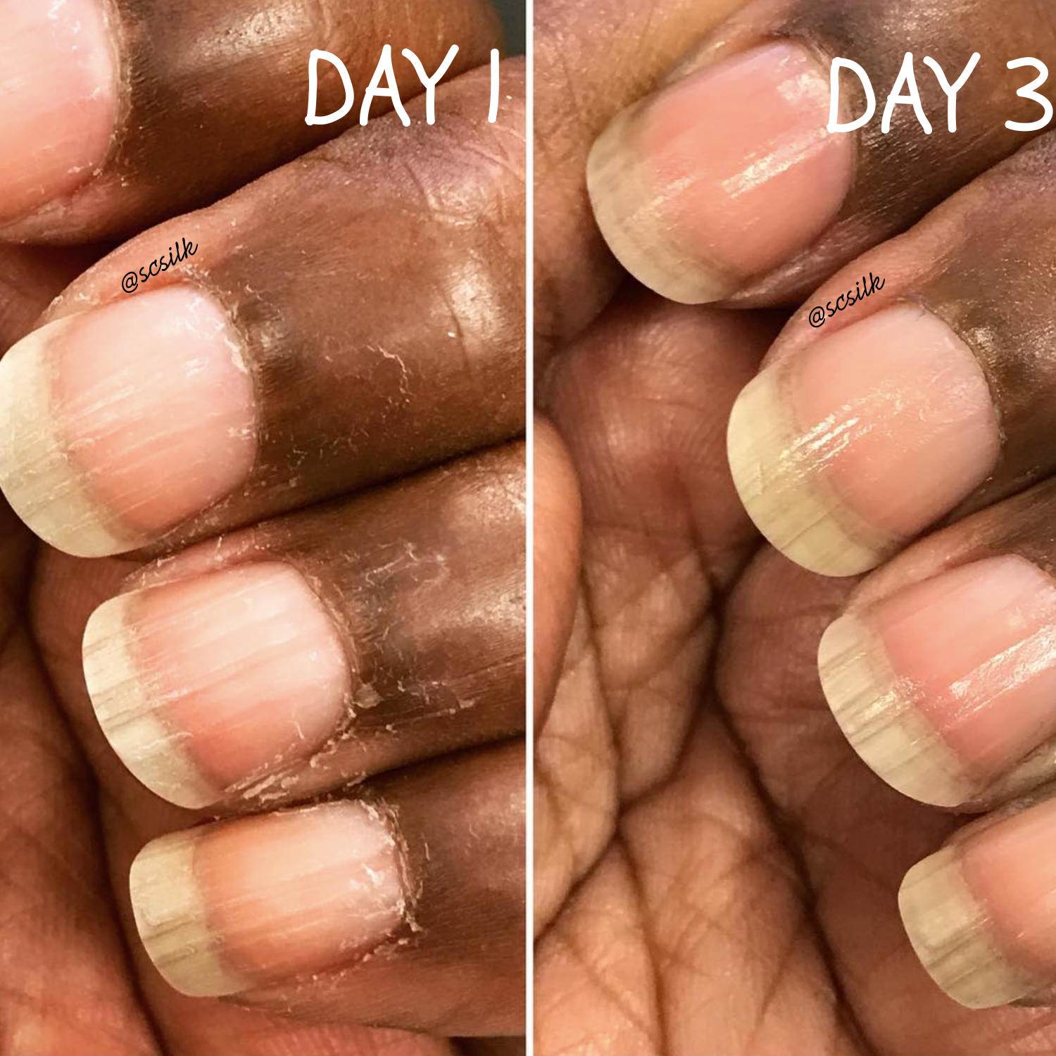 @scsilk
Two images are shown.
First one is titled Day 1.
It shows a hand with cracked finger tips around the nail. cry and needing assistance.
Day 3
it shows the nails received some nourishing Bliss Kiss oil. looking much healthier. little to no cracked skin.