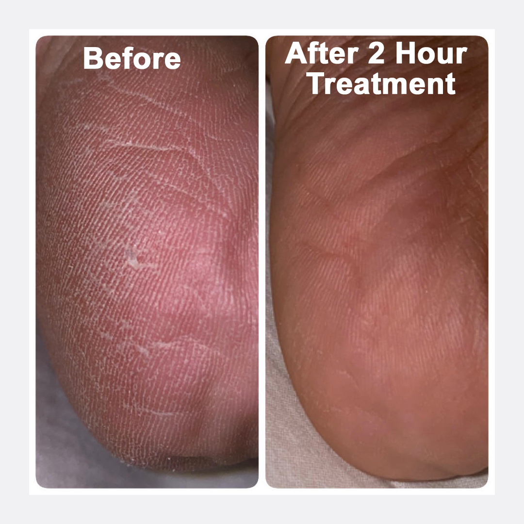 the image shows a close up before and after of the heel of a foot.
Before it's cracked and completely covered in dead skin. the skin looks dull. after a two hour session it looks glowing, clean, and nourished.