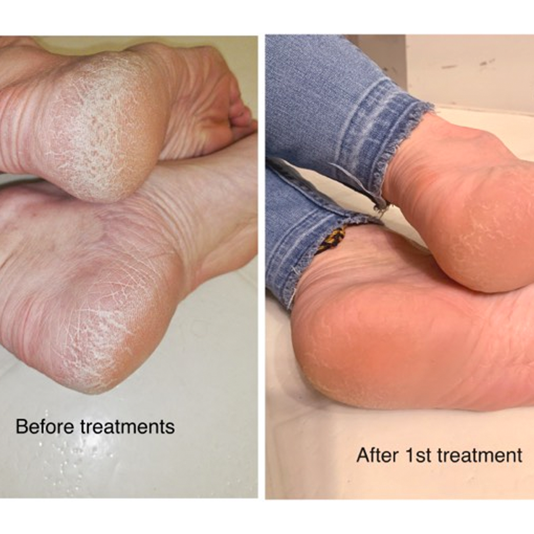 Image shows a before and after image of a set of feet, close up of the heels.
Before is dry, cracking, and caked in dead skin. Looking uncomfortable and dry.
After the first session the cracking looks sealed. the dead skin is gone, and the skin is slightly pink and healthy.