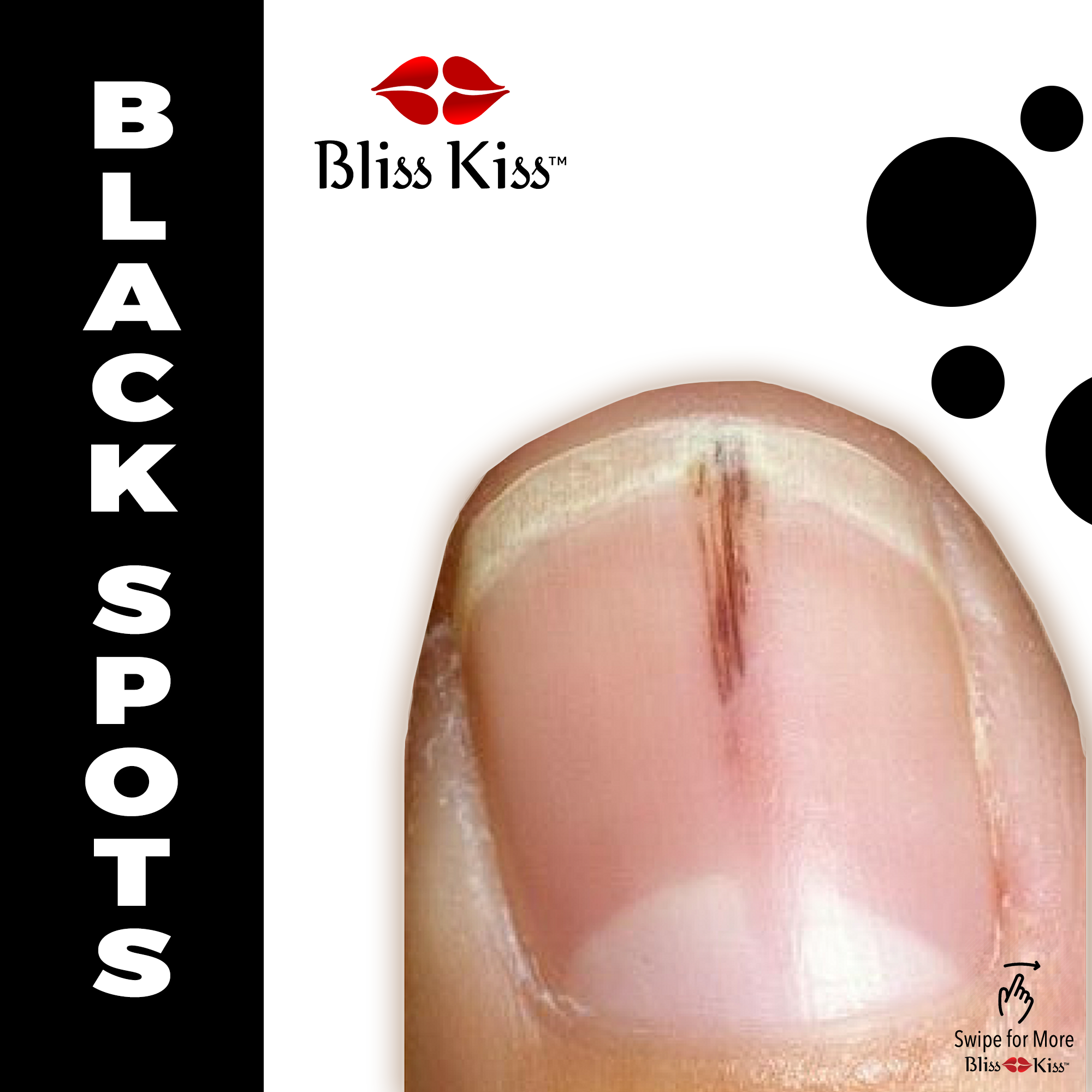 Image depicts a finger with a nail with a long black smear imbedded in the nail. The text reads "BLACK SPOTS" in bold. the background consists of white with black spots on the right hand side. 