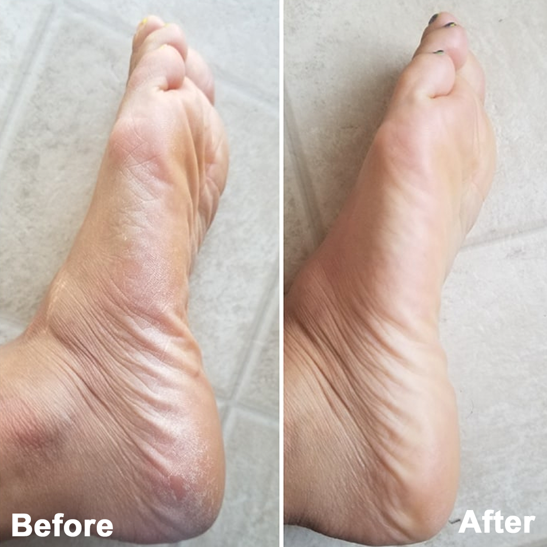 Image shows a before and after of a foot. 
Before the foot is cracked and covered in dead skin. after the food looks very clean and healthy. smooth and shiny. free of dead skin. 