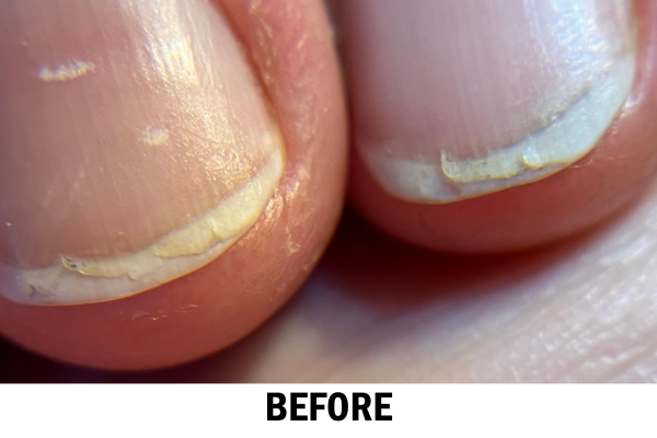 Image shows closeup of chipped nails. the nails are peeling and cracked. the bottom text is "Before"